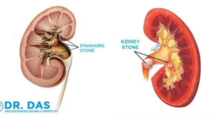 Kidney Stone Treatments In Bahrain